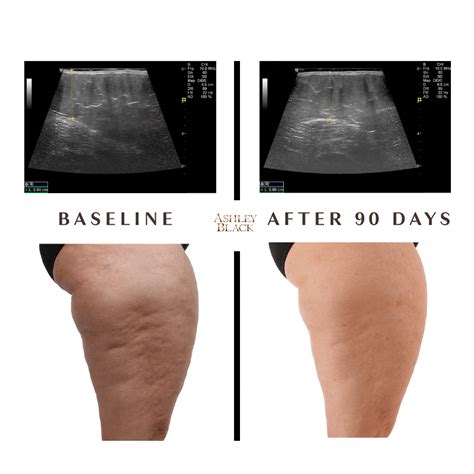 fascia blasting results|FasciaBlasting 101 .